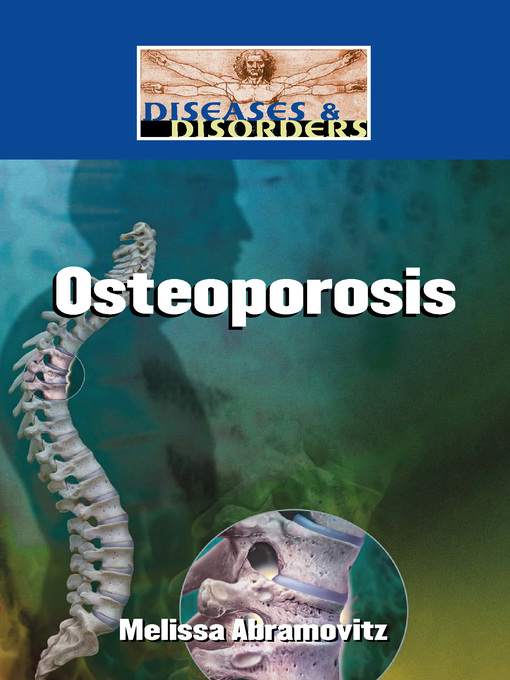 Title details for Osteoporosis by Melissa Abramovitz - Available